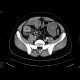 ileus, small bowel obstruction on terminal ileum: CT - Computed tomography