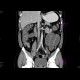 ileus, small bowel obstruction on terminal ileum: CT - Computed tomography