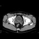 Intramural ureterolithiasis: CT - Computed tomography