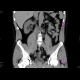 Intramural ureterolithiasis: CT - Computed tomography