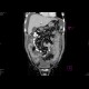 Carcinosis of mesentery: CT - Computed tomography