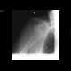 Luxation of the shoulder, caudal, axillary: X-ray - Plain radiograph