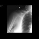 Luxation of the shoulder, caudal, axillary: X-ray - Plain radiograph