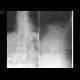 Compression fracture, first lumbar vertebra, osteoporosis: X-ray - Plain radiograph