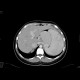 Congenital liver fibrosis, portal hypertension, porto-venous shunts: CT - Computed tomography