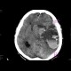 Intraparenchymal hemorrhage: CT - Computed tomography
