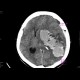 Intraparenchymal hemorrhage: CT - Computed tomography