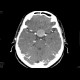 Adenoma of hypophysis, before and after resection: CT - Computed tomography