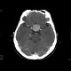 Adenoma of hypophysis, before and after resection: CT - Computed tomography