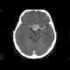 Adenoma of hypophysis, before and after resection: CT - Computed tomography