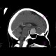 Adenoma of hypophysis, before and after resection: CT - Computed tomography