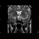 Adenoma of hypophysis, before and after resection: X-ray - Plain radiograph
