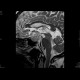 Adenoma of hypophysis, before and after resection: MRI - Magnetic Resonance Imaging