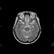 Adenoma of hypophysis, before and after resection: MRI - Magnetic Resonance Imaging