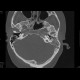 Mastoiditis, mesotitis: CT - Computed tomography