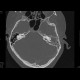 Mastoiditis, mesotitis: CT - Computed tomography