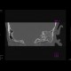 Mastoiditis, mesotitis: CT - Computed tomography