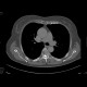 Meningioma of the spinal canal: CT - Computed tomography