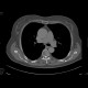 Meningioma of the spinal canal: CT - Computed tomography