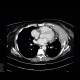 Myeloma of thorax wall: CT - Computed tomography