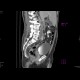 Renal cell carcinoma, thrombosis of the inferior vena cava: CT - Computed tomography