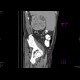 Renal cell carcinoma, thrombosis of the inferior vena cava: CT - Computed tomography