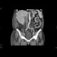 Renal cell carcinoma, renal vein thrombosis, thrombosis of the inferior vena cava: CT - Computed tomography