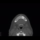 Odontoma: CT - Computed tomography