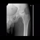 Osteonecrosis of head of femur: X-ray - Plain radiograph