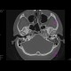 Osteoma of external auditory meatus: CT - Computed tomography