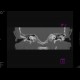 Osteoma of external auditory meatus: CT - Computed tomography