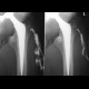 Hip replacement, osteomyelitis, fistula of hip joint: X-ray - Plain radiograph