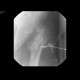 Hip replacement, osteomyelitis, fistula of hip joint: RF - Fluoroscopy