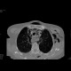 Perforation of oesophagus, pneumomediastinum: CT - Computed tomography