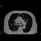 Perforation of oesophagus, pneumomediastinum: CT - Computed tomography