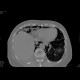 Perforation of oesophagus, pneumomediastinum: CT - Computed tomography