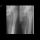 Phlebography: X-ray - Plain radiograph