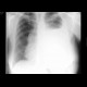 Pleural effusion: X-ray - Plain radiograph