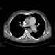 Pulmonary embolism, thrombolysis: CT - Computed tomography