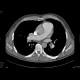 Pulmonary embolism, thrombolysis: CT - Computed tomography
