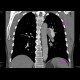 Pulmonary embolism, thrombolysis: CT - Computed tomography