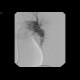 Pulmonary embolism, thrombolysis: AG - Angiography