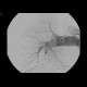 Pulmonary embolism, thrombolysis: AG - Angiography