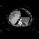 Bowel ischemia, gas in portal vein and liver: CT - Computed tomography