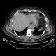 Ectopic pancreas, gigantic, pancreatic ectopia: CT - Computed tomography