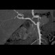 Polyarteritis nodosa: CT - Computed tomography