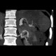 Polyarteritis nodosa: CT - Computed tomography
