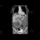 Polycystosis of liver and kidney: CT - Computed tomography