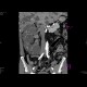 Polycystosis of kidney and liver: CT - Computed tomography