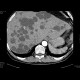 Polycystosis of kidney and liver: CT - Computed tomography